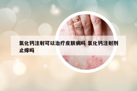 氯化鈣注射可以治療皮膚病嗎 氯化鈣注射劑止癢嗎