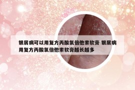 銀屑病可以用復(fù)方丙酸氯倍他索軟膏 銀屑病用復(fù)方丙酸氯倍他索軟膏越長越多