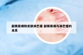 副銀屑病和皮膚淋巴瘤 副銀屑病與淋巴瘤的關(guān)系