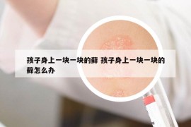 孩子身上一塊一塊的蘚 孩子身上一塊一塊的蘚怎么辦