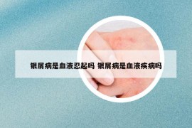 銀屑病是血液忍起嗎 銀屑病是血液疾病嗎