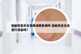 接觸性皮炎會(huì)發(fā)展成銀屑病嗎 接觸性皮炎會(huì)自行消退嗎?