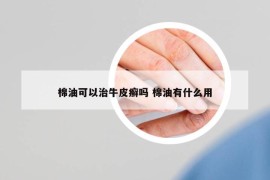 棉油可以治牛皮癬嗎 棉油有什么用