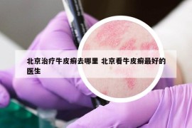 北京治療牛皮癬去哪里 北京看牛皮癬最好的醫(yī)生