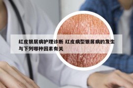 紅皮銀屑病護理診斷 紅皮病型銀屑病的發(fā)生與下列哪種因素有關(guān)