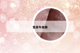 黨員牛皮癬