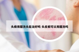 頭癬用醋洗頭能治好嗎 頭皮癬可以用醋洗嗎