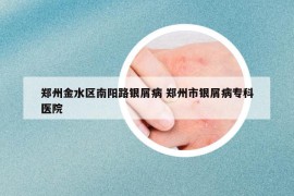 鄭州金水區(qū)南陽路銀屑病 鄭州市銀屑病?？漆t(yī)院