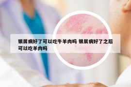 銀屑病好了可以吃牛羊肉嗎 銀屑病好了之后可以吃羊肉嗎