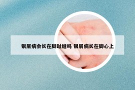 銀屑病會(huì)長(zhǎng)在腳趾縫嗎 銀屑病長(zhǎng)在腳心上