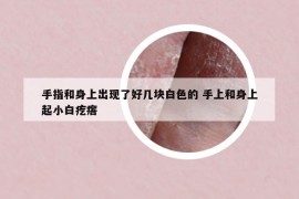 手指和身上出現(xiàn)了好幾塊白色的 手上和身上起小白疙瘩