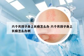 六個月孩子身上長癬怎么辦 六個月孩子身上長癬怎么辦啊