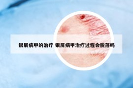 銀屑病甲的治療 銀屑病甲治療過(guò)程會(huì)脫落嗎