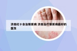 濟(jì)南紅十會(huì)治銀屑病 濟(jì)南治療銀屑病最好的醫(yī)生