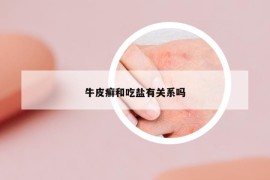 牛皮癬和吃鹽有關(guān)系嗎