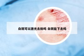 白斑可以激光去除嗎 白斑能下去嗎
