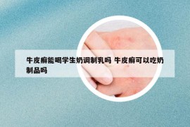 牛皮癬能喝學(xué)生奶調(diào)制乳嗎 牛皮癬可以吃奶制品嗎