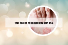 銀屑病和糖 銀屑病和糖尿病的關(guān)系