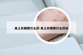 身上長癬擦什么藥 身上長癬擦什么藥水