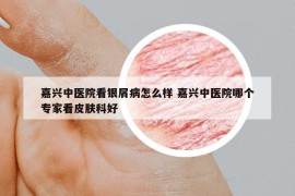 嘉興中醫(yī)院看銀屑病怎么樣 嘉興中醫(yī)院哪個(gè)專家看皮膚科好