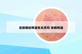 皮膚癬給喝酒有關(guān)系嗎 體癬喝酒
