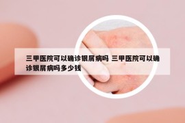 三甲醫(yī)院可以確診銀屑病嗎 三甲醫(yī)院可以確診銀屑病嗎多少錢