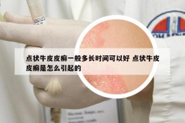 點狀牛皮皮癬一般多長時間可以好 點狀牛皮皮癬是怎么引起的
