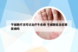干細(xì)胞療法可以治療牛皮癬 干細(xì)胞能治愈銀屑病嗎