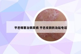 平邑哪里治銀屑病 平邑皮膚防治站電話