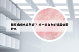 銀屑病喝水突然好了 唯一能自愈的銀屑病是什么