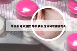 牛皮癬用沐浴露 牛皮膚癬洗澡可以用香皂嗎