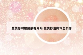 蘭美抒對(duì)銀屑病有用嗎 蘭美抒治腳氣怎么樣