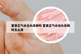 藿香正氣水治頭皮癬嗎 藿香正氣水治頭皮癬嗎怎么用
