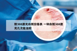 照308激光白斑價格表 一塊白斑308激光幾次能治好