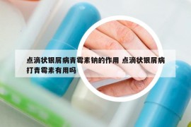 點滴狀銀屑病青霉素鈉的作用 點滴狀銀屑病打青霉素有用嗎