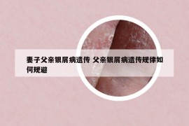妻子父親銀屑病遺傳 父親銀屑病遺傳規(guī)律如何規(guī)避
