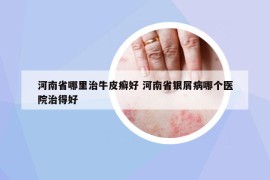 河南省哪里治牛皮癬好 河南省銀屑病哪個醫(yī)院治得好