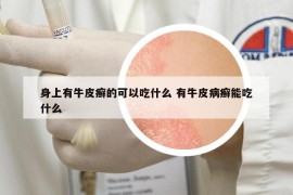 身上有牛皮癬的可以吃什么 有牛皮病癬能吃什么