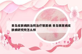 青島皮膚病防治院治療銀屑病 青島銀屑病皮膚病研究院怎么樣