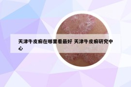 天津牛皮癬在哪里看最好 天津牛皮癬研究中心