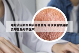 哈爾濱治銀屑病去哪里最好 哈爾濱治銀屑病去哪里最好的醫(yī)院