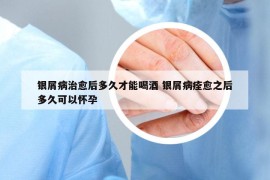 銀屑病治愈后多久才能喝酒 銀屑病痊愈之后多久可以懷孕