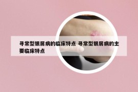 尋常型銀屑病的臨床特點(diǎn) 尋常型銀屑病的主要臨床特點(diǎn)