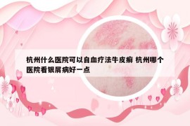 杭州什么醫(yī)院可以自血療法牛皮癬 杭州哪個醫(yī)院看銀屑病好一點