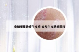 安陽哪里治療牛皮癬 安陽牛皮膚癬醫(yī)院