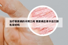 治療銀屑病的卡博三純 銀屑病總用卡泊三醇乳膏好嗎