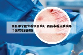 西昌哪個醫(yī)生看銀屑病好 西昌市看皮膚病那個醫(yī)院看的好些