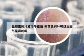 無花果樹汁液治牛皮癬 無花果樹葉可以治腳氣是真的嗎