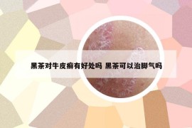 黑茶對牛皮癬有好處嗎 黑茶可以治腳氣嗎
