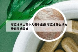 石家莊橫山那個人看牛皮癬 石家莊什么地方看銀屑病最好